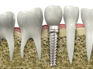 dental-implants-can-be-used-to-replace-single-teeth-or-permanently-anchor-a-full-mouth-denture