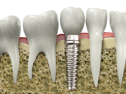 dental-implants-can-be-used-to-replace-single-teeth-or-permanently-anchor-a-full-mouth-denture