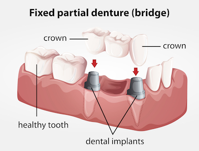 fixed-partial-denture-bridge