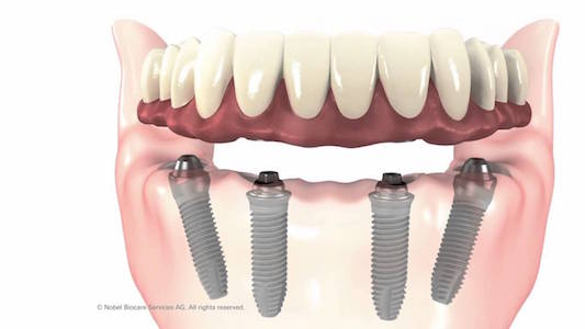hybrid-dentures-are-anchored-directly-on-top-of-dental-implants-and-can-be-permanently-fixed-in-place-for-removable-for-easy-cleaning