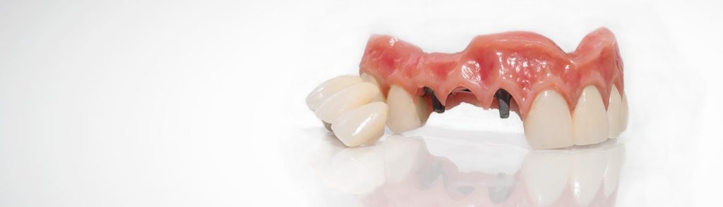 dental-impant-solutionz-boasts-a-high-precision-cad-cam-titanium-denture-substructure-with-and-incredible-life-like-gingival-composite