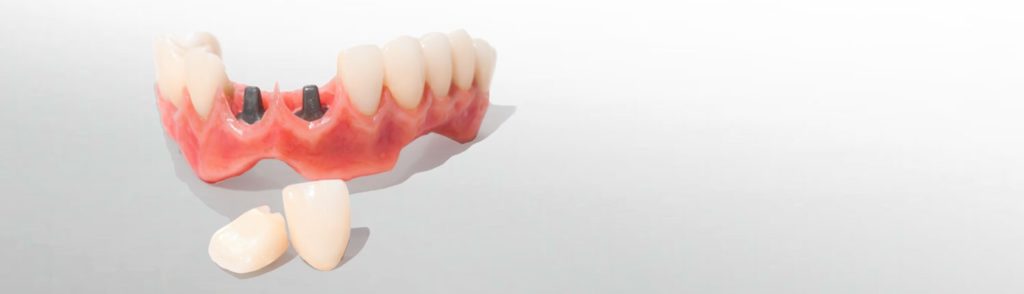 flossable-hybrid-denture
