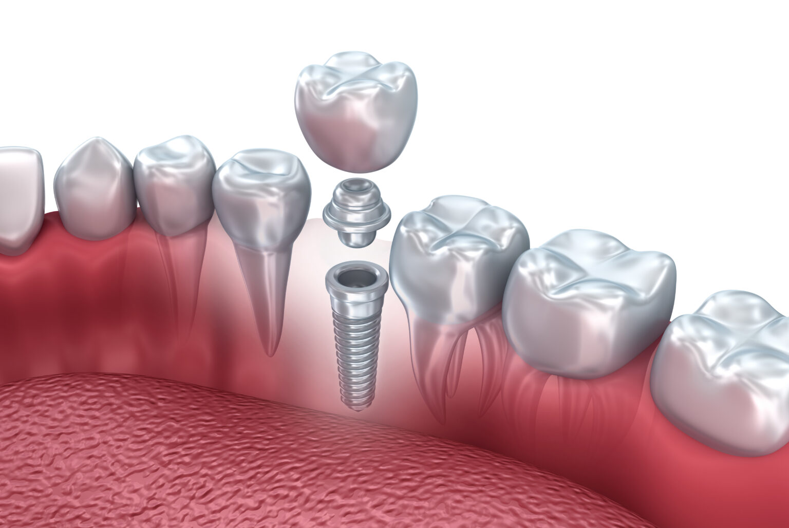 Tooth Extraction Vs A Crown