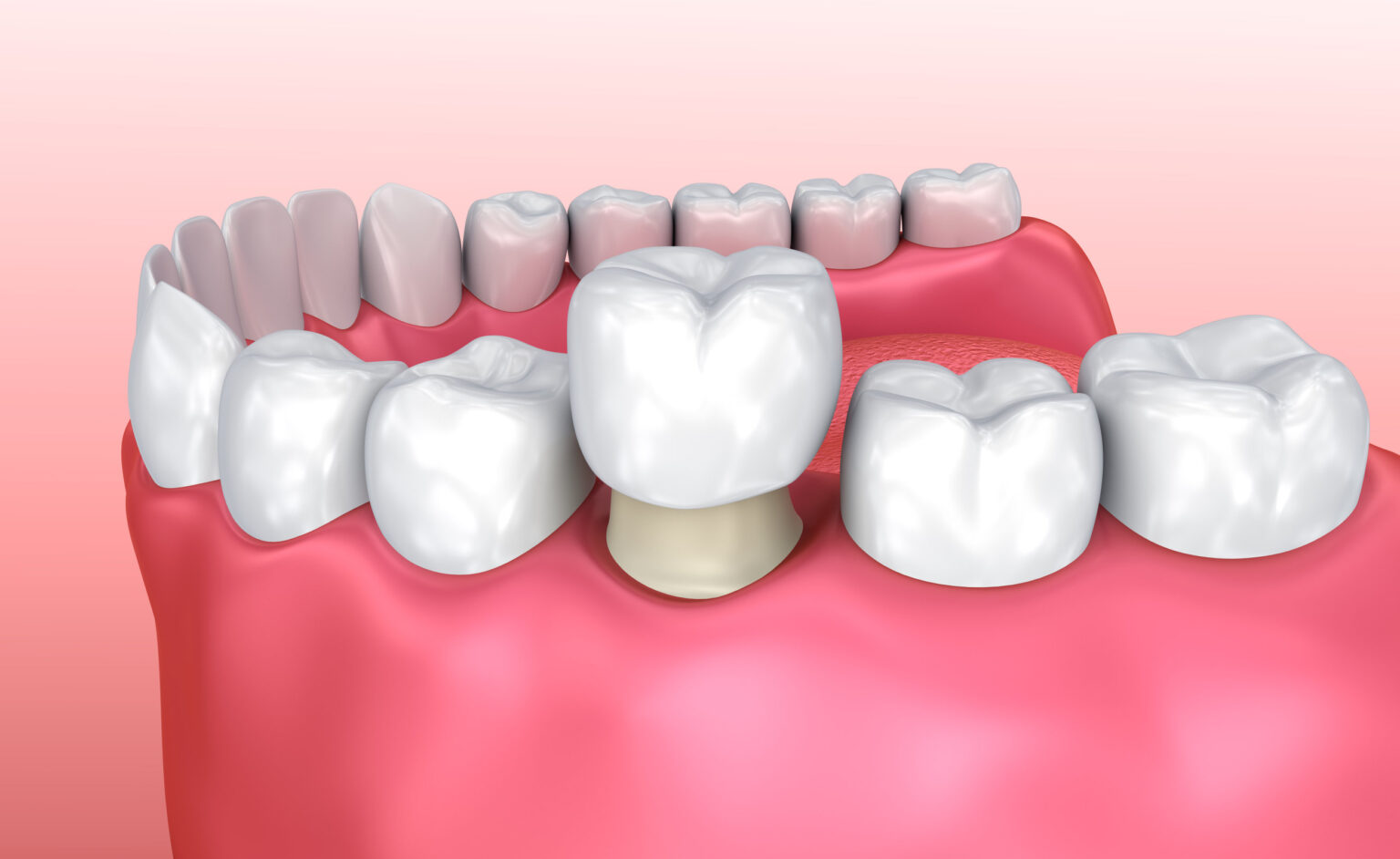 Types of Dental Crowns